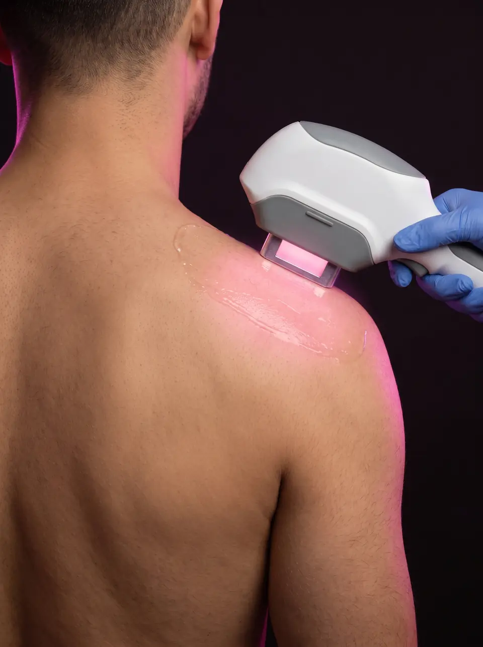 Laser handpiece on a man's upper back, at the shoulder blade