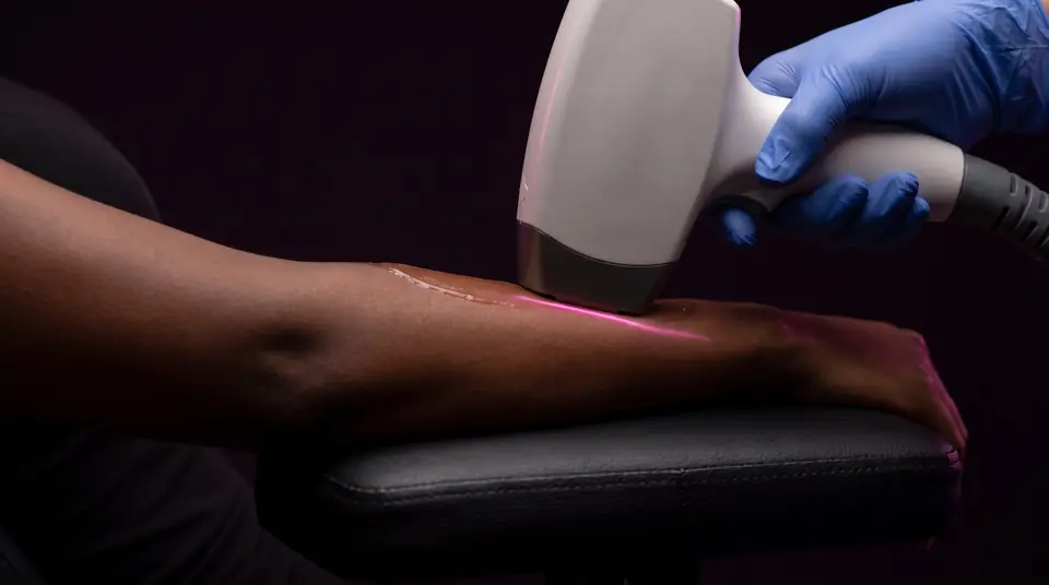 A gloved hand holds a laser handpiece flat on a deep-brown forearm, a thin pink glow at the contact